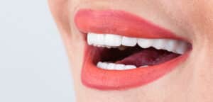 press,ceramic,crowns,and,veneers,bleach,color